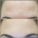Plasma Pen Forehead Line Removal
